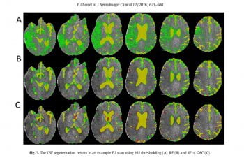 Machine learning approach to segment regions of cerebrospinal fluid (CSF) from CT scans after stroke. A shows thresholding approach with significant false positives (green). B shows the random forest approach (Yellow is true positive segmentation). C shows the refined results using active contouring to correct segmentation.