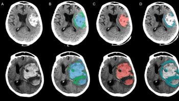 Two slices from the CT of a patient with large intracerebral hemorrhage (left column). Manual segmentation of blood (blue) and perihematomal edema (green) is shown in the second column. Automated segmentation of blood (red, third column) and edema (teal, right column) is shown, using a deep learning algorithm.