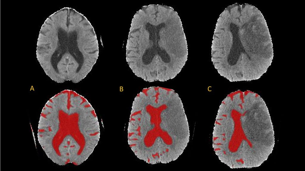 Frontiers Figure 2: Automated segmentation of CSF regions (red) from serial CT scans highlighting the loss of CSF as cerebral edema evolves after stroke