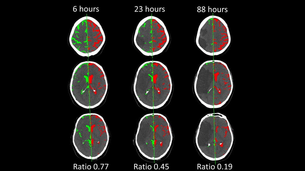 Separation of CSF segmentation (using a deep learning approach) into two hemispheres using a registered midline. Green regions are ipsilateral to the stroke and red are contralateral. The hemispheric CSF ratio is the ratio of the ipsilateral to contralateral CSF volumes. Shown is how the CSF ratio decreases in stroke patients with edema over the first days after stroke.