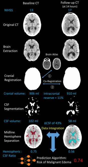 Workflow to analyze baseline and follow-up CT scans after stroke to extract volumetric markers of edema (change in CSF volume, hemispheric CSF ratio)