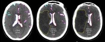Volumetric reductions in CSF compartments as edema develops after stroke