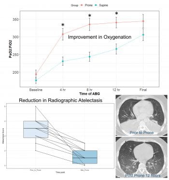 Results of study comparing prone to supine ventilation - top graph shows improvement in oxygenation over time between two groups. Lower boxplot shows reduction in atelectasis severity on chest CT scans in the prone group before versus after proning. CT scan images at bottom right shows atelectasis prior to proning and improvement after 12-hours of ventilation in the prone position.